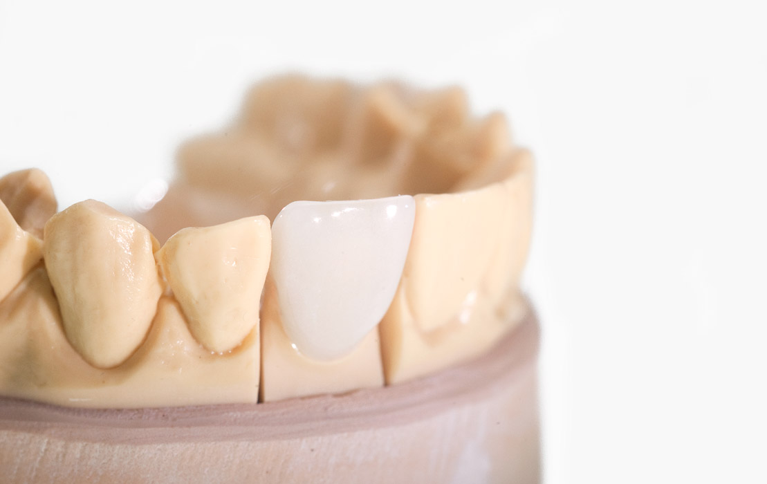 Zahnersatz bei der Zahnarztpraxis Purger in Krumbach